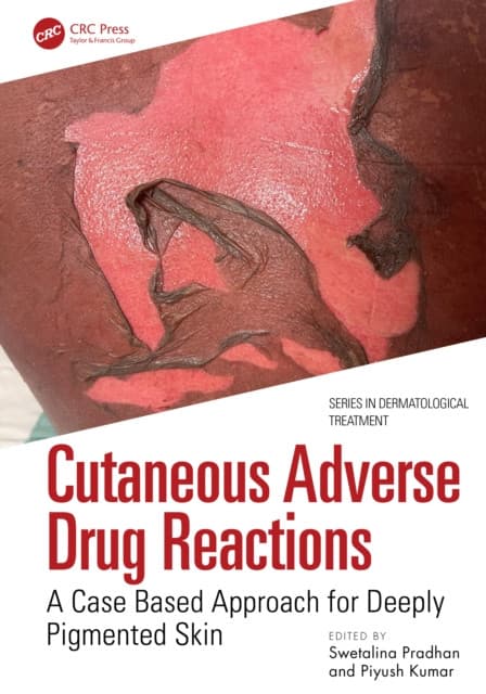 Cutaneous Adverse Drug Reactions