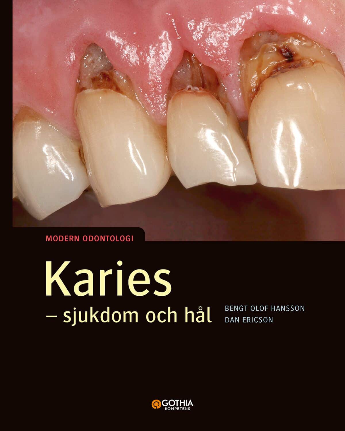 Karies : sjukdom och hål av Bengt Olof Hansson